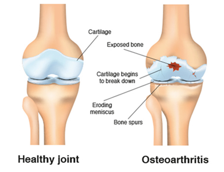 osteoarthritis in knee